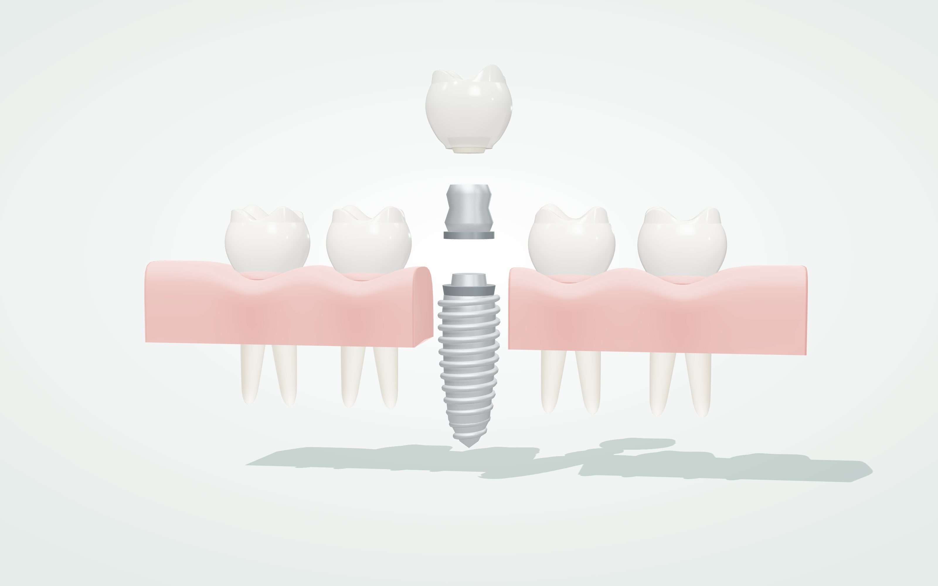 A 3D illustration of an implant shown in three separated pieces — crown, abutment and post — between two natural teeth in cross-section.